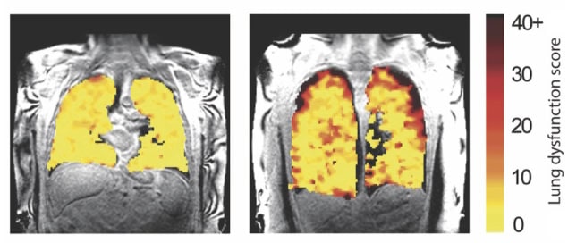 Lung function MRI